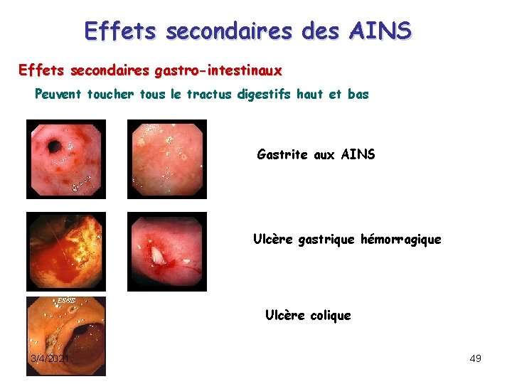 Effets secondaires des AINS Effets secondaires gastro-intestinaux Peuvent toucher tous le tractus digestifs haut Effets secondaires des AINS Effets secondaires gastro-intestinaux Peuvent toucher tous le tractus digestifs haut