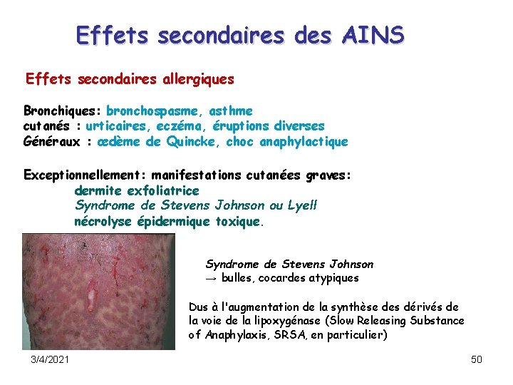Effets secondaires des AINS Effets secondaires allergiques Bronchiques: bronchospasme, asthme cutanés : urticaires, eczéma, Effets secondaires des AINS Effets secondaires allergiques Bronchiques: bronchospasme, asthme cutanés : urticaires, eczéma,