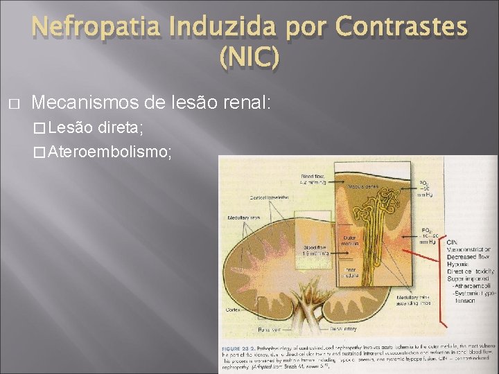 Nefropatia Induzida por Contrastes (NIC) � Mecanismos de lesão renal: � Lesão direta; �