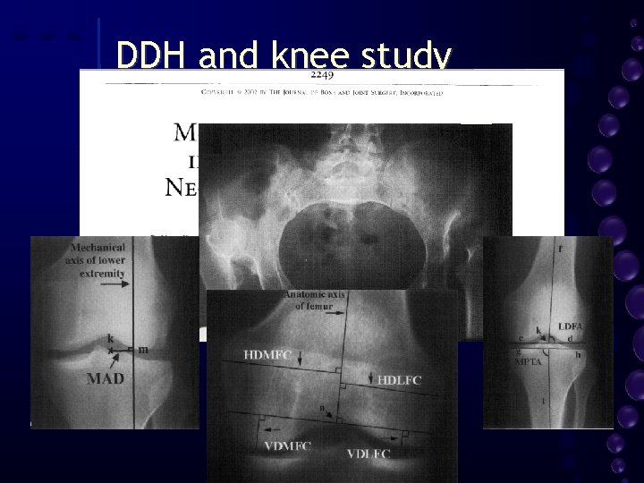 DDH and knee study 