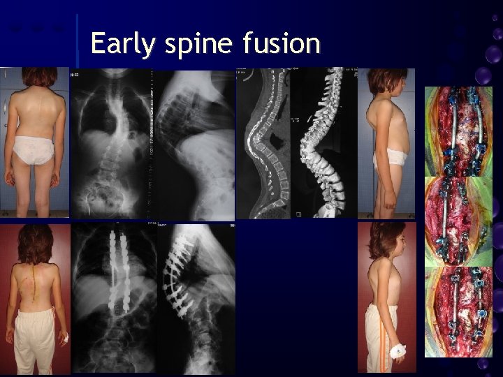 Early spine fusion 