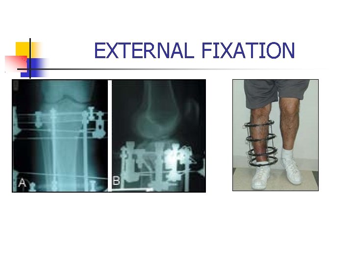 EXTERNAL FIXATION 