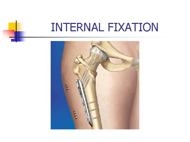 INTERNAL FIXATION 