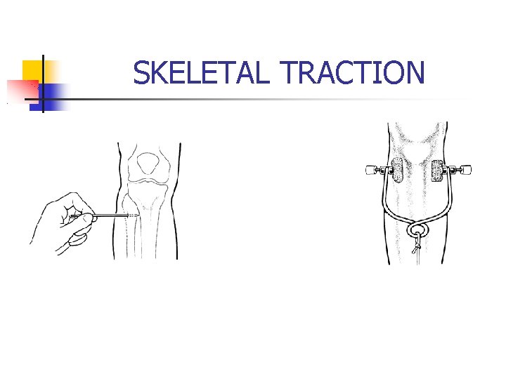 SKELETAL TRACTION 