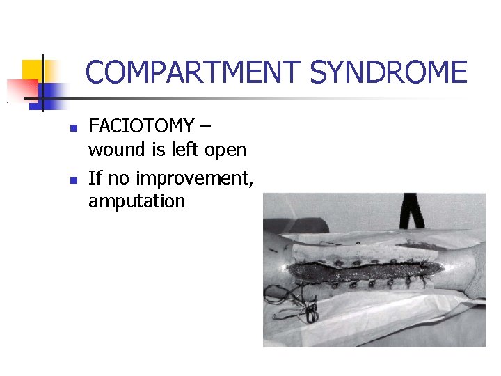COMPARTMENT SYNDROME FACIOTOMY – wound is left open If no improvement, amputation 