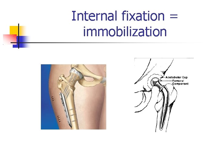 Internal fixation = immobilization 