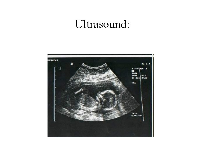 Ultrasound: 