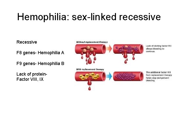 Hemophilia: sex-linked recessive Recessive F 8 genes- Hemophilia A F 9 genes- Hemophilia B