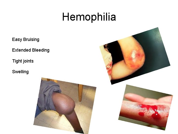 Hemophilia Easy Bruising Extended Bleeding Tight joints Swelling 