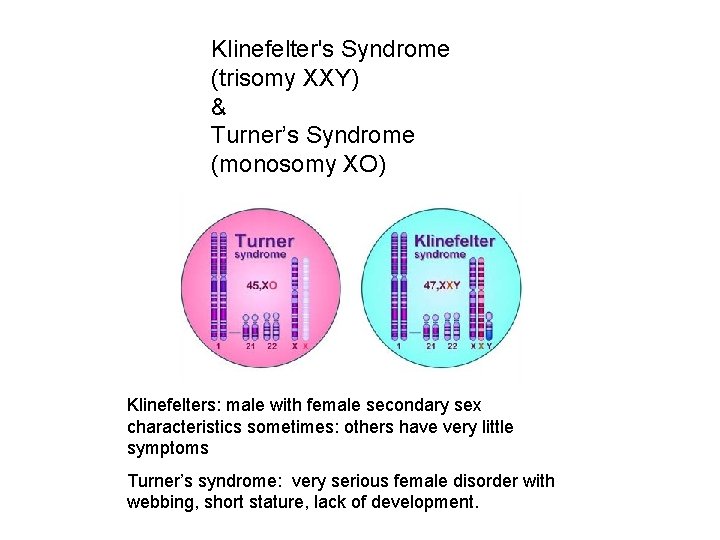 Klinefelter's Syndrome (trisomy XXY) & Turner’s Syndrome (monosomy XO) Klinefelters: male with female secondary