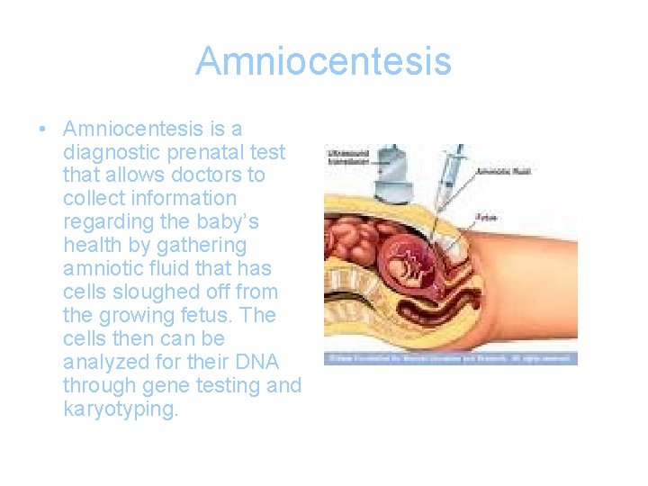 Amniocentesis • Amniocentesis is a diagnostic prenatal test that allows doctors to collect information