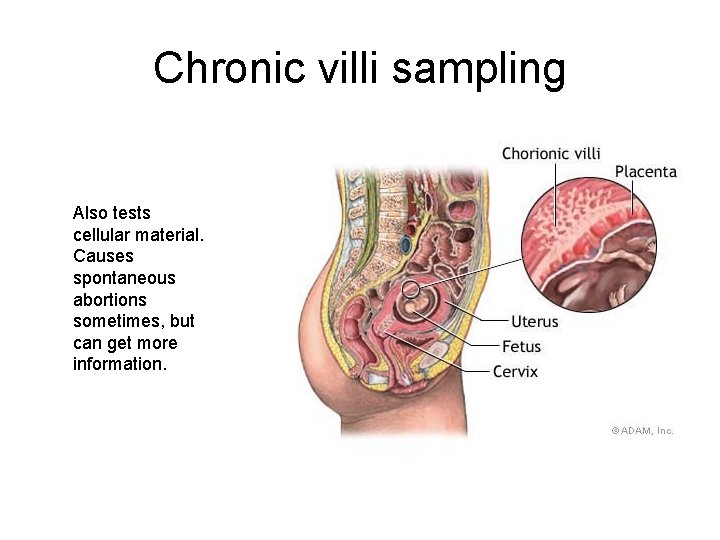 Chronic villi sampling Also tests cellular material. Causes spontaneous abortions sometimes, but can get