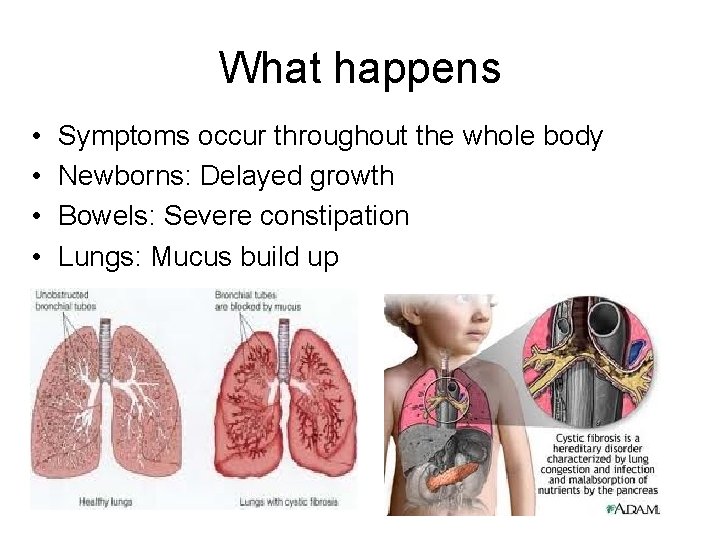 What happens • • Symptoms occur throughout the whole body Newborns: Delayed growth Bowels: