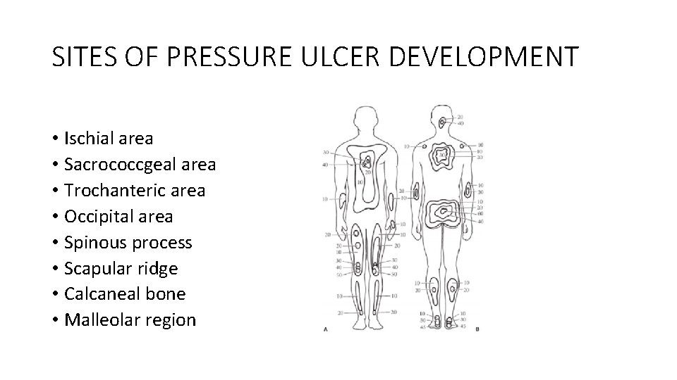 SITES OF PRESSURE ULCER DEVELOPMENT • Ischial area • Sacrococcgeal area • Trochanteric area