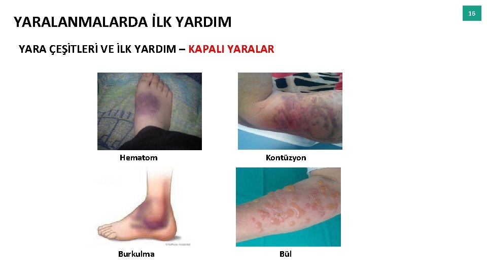 16 YARALANMALARDA İLK YARDIM YARA ÇEŞİTLERİ VE İLK YARDIM – KAPALI YARALAR Hematom Kontüzyon