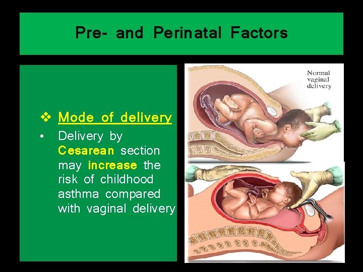 Pre- and Perinatal Factors v Mode of delivery • Delivery by Cesarean section may