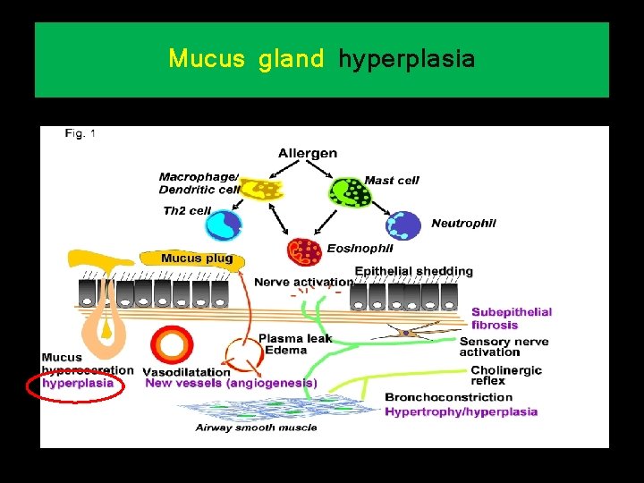 Mucus gland hyperplasia 