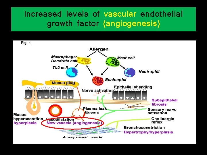 increased levels of vascular endothelial growth factor (angiogenesis) 