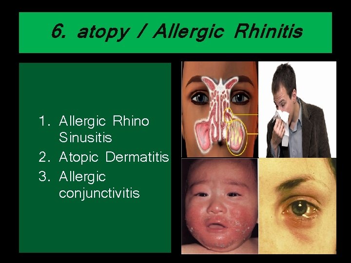 6. atopy / Allergic Rhinitis 1. Allergic Rhino Sinusitis 2. Atopic Dermatitis 3. Allergic