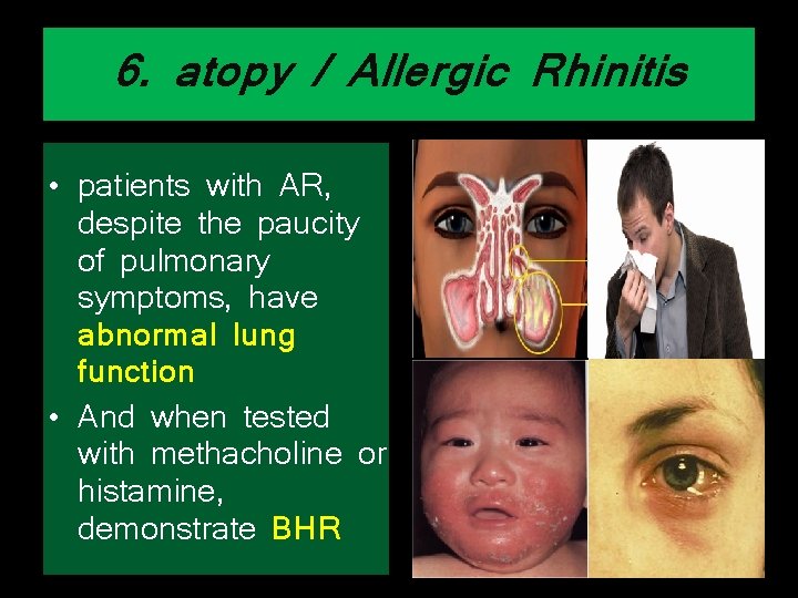 6. atopy / Allergic Rhinitis • patients with AR, despite the paucity of pulmonary