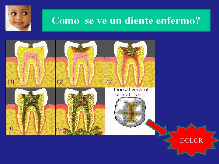 Como se ve un diente enfermo? DOLOR Como se ve un diente enfermo? DOLOR