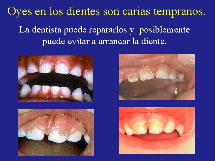 Oyes en los dientes son carias tempranos. La dentista puede repararlos y posiblemente puede Oyes en los dientes son carias tempranos. La dentista puede repararlos y posiblemente puede
