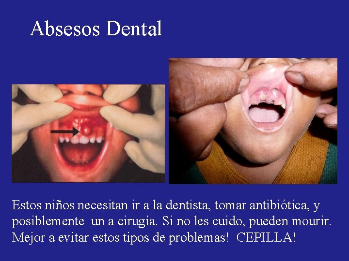 Absesos Dental Estos niños necesitan ir a la dentista, tomar antibiótica, y posiblemente un Absesos Dental Estos niños necesitan ir a la dentista, tomar antibiótica, y posiblemente un
