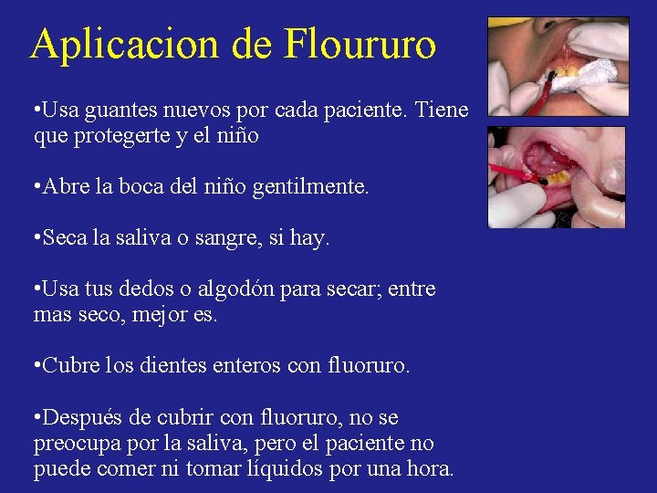 Aplicacion de Floururo • Usa guantes nuevos por cada paciente. Tiene que protegerte y Aplicacion de Floururo • Usa guantes nuevos por cada paciente. Tiene que protegerte y