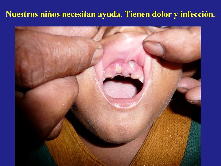 Nuestros niños necesitan ayuda. Tienen dolor y infección. Nuestros niños necesitan ayuda. Tienen dolor y infección.
