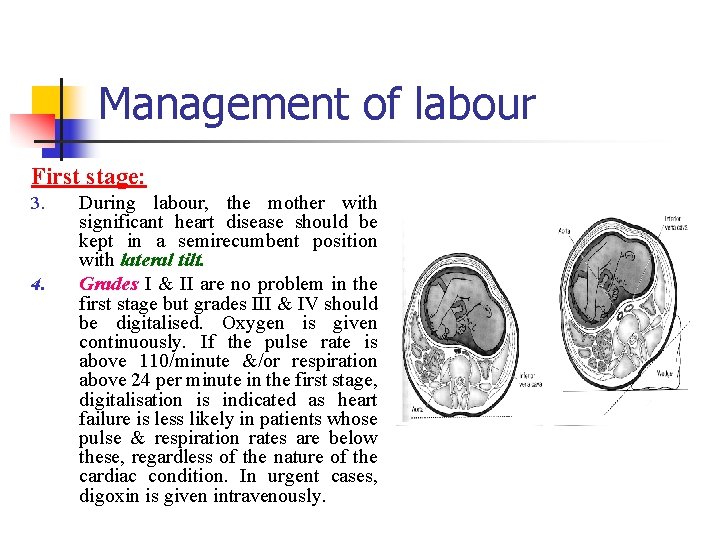 Management of labour First stage: 3. 4. During labour, the mother with significant heart