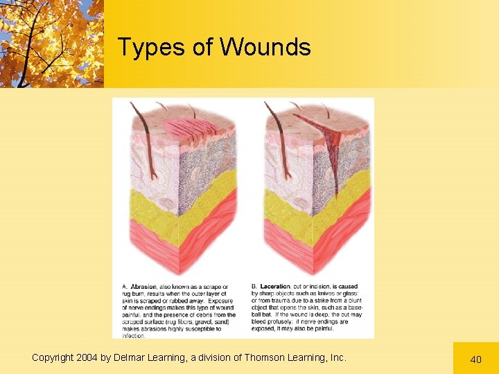 Types of Wounds Copyright 2004 by Delmar Learning, a division of Thomson Learning, Inc. Types of Wounds Copyright 2004 by Delmar Learning, a division of Thomson Learning, Inc.