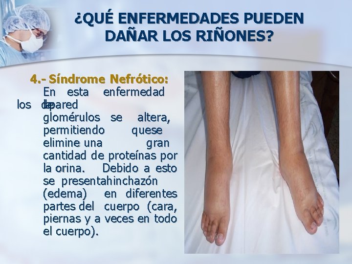 ¿QUÉ ENFERMEDADES PUEDEN DAÑAR LOS RIÑONES? 4. - Síndrome Nefrótico: En esta enfermedad los