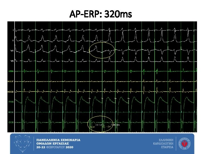 AP-ERP: 320 ms 