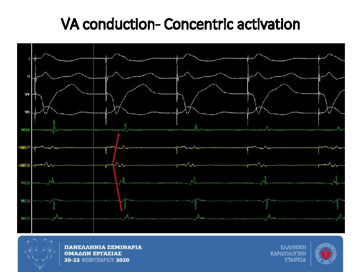 VA conduction- Concentric activation 