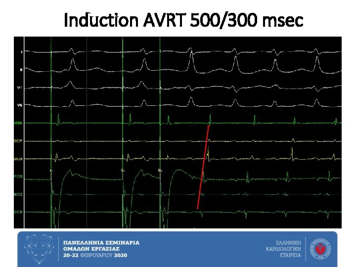 Induction AVRT 500/300 msec 