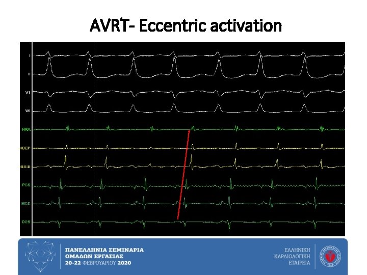 AVRT- Eccentric activation 