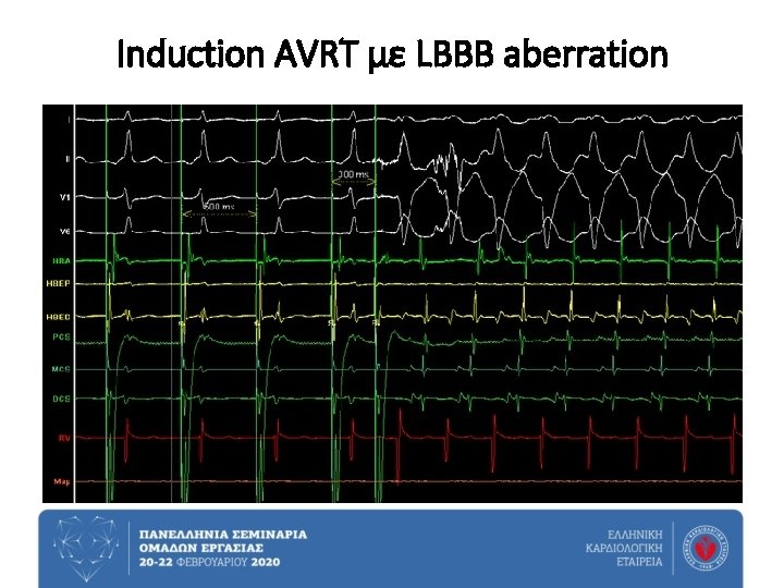 Induction AVRT με LBBB aberration 