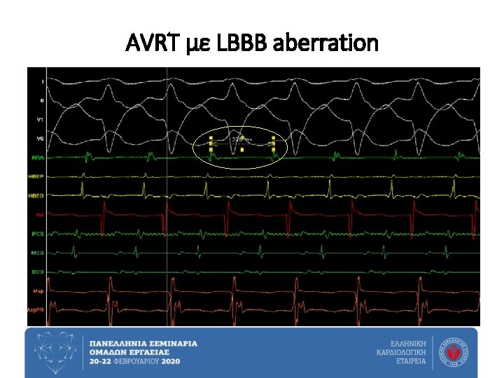 AVRT με LBBB aberration 