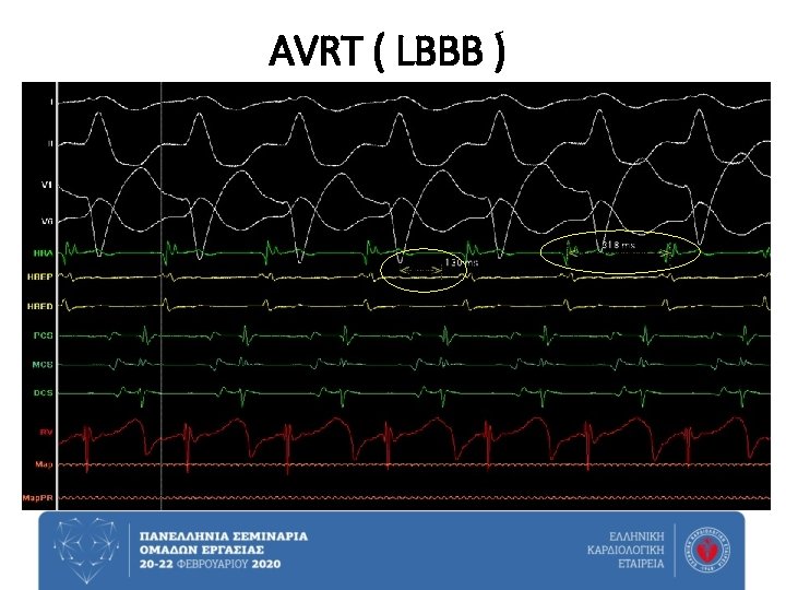 AVRT ( LBBB ) 