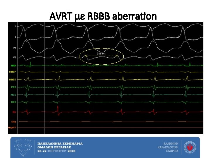AVRT με RBBB aberration 