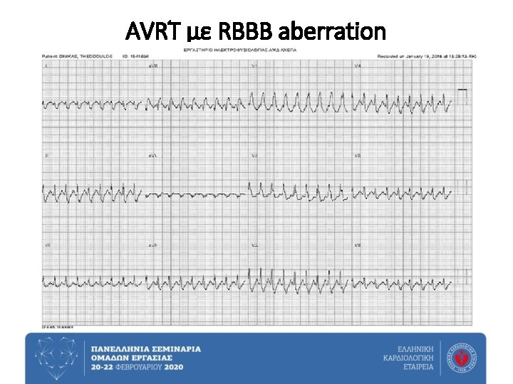 AVRT με RBBB aberration 