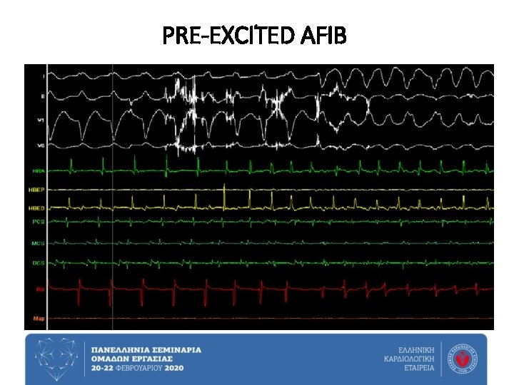 PRE-EXCITED AFIB 