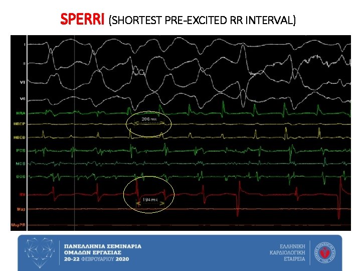 SPERRI (SHORTEST PRE-EXCITED RR INTERVAL) 