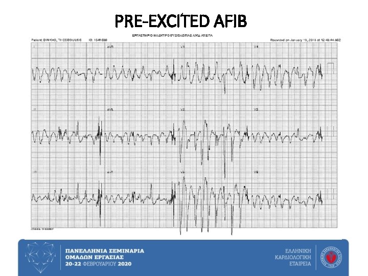 PRE-EXCITED AFIB 