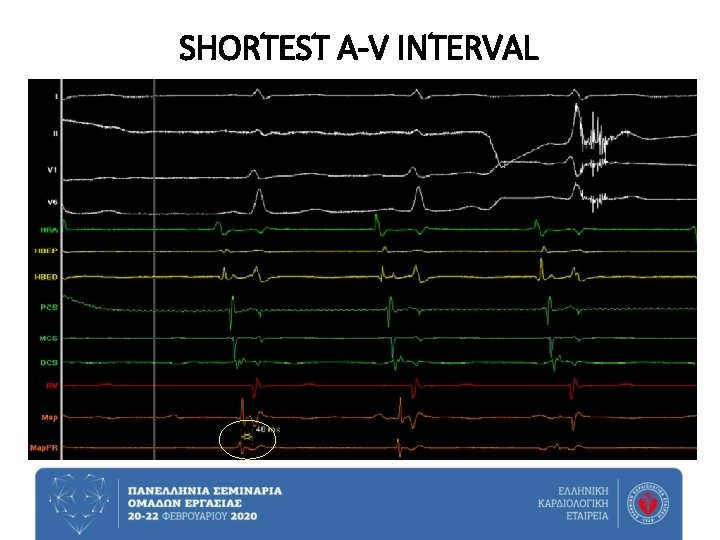 SHORTEST A-V INTERVAL 