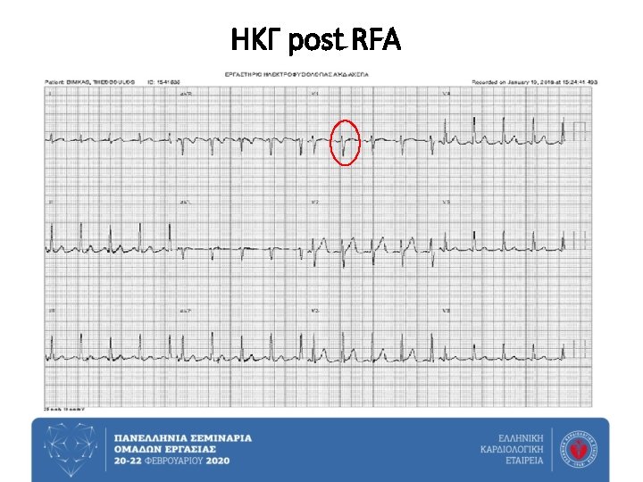 ΗΚΓ post RFA 