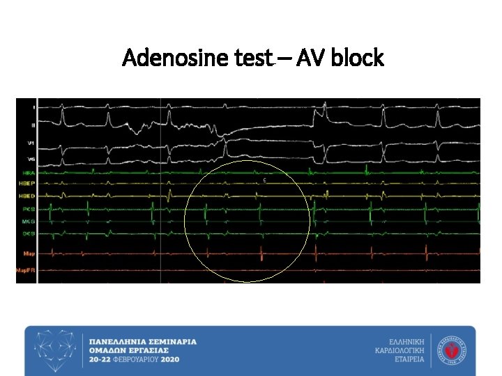 Adenosine test – AV block 