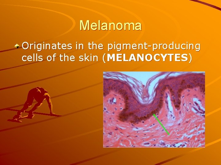Melanoma Originates in the pigment-producing cells of the skin (MELANOCYTES) 