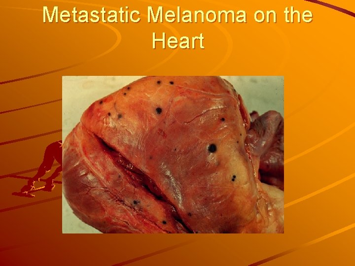 Metastatic Melanoma on the Heart 