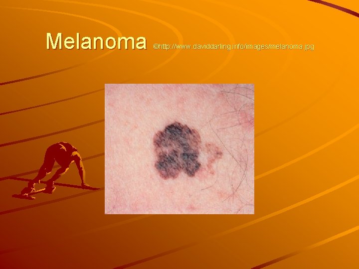 Melanoma ©http: //www. daviddarling. info/images/melanoma. jpg 
